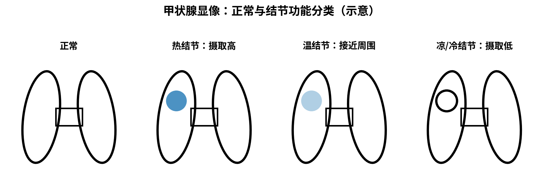 图：甲状腺正常、热结节、温结节、冷结节示意