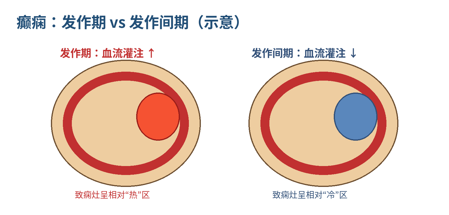 图3  癫痫发作期/发作间期的灌注方向（示意图）