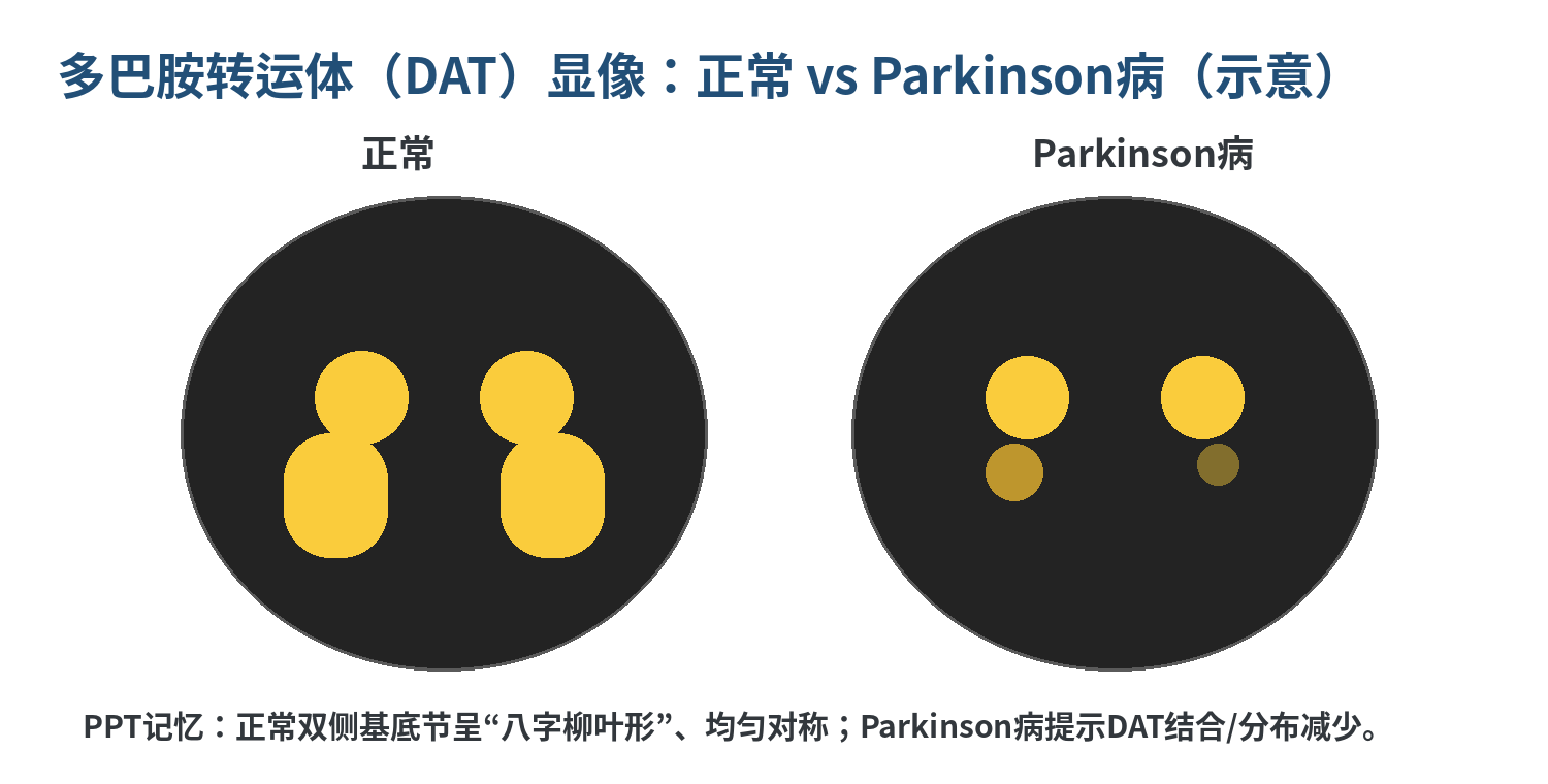 图4  DAT显像正常与Parkinson病的核心差别（示意图）