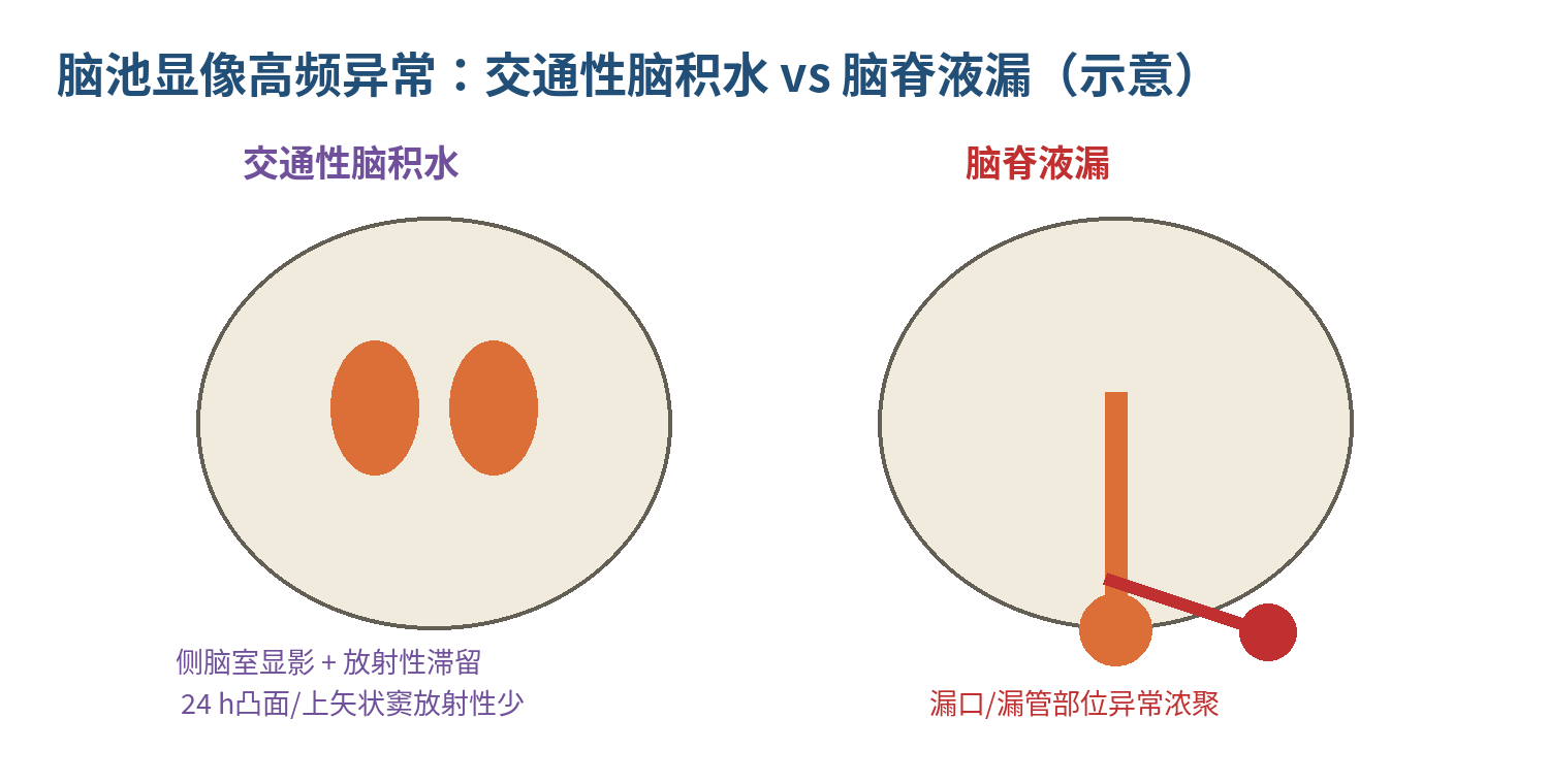 图6  交通性脑积水与脑脊液漏的高频判读（示意图）